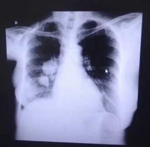 lung_cancer_x_ray_330x325