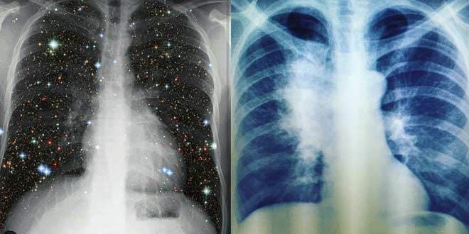 Early Signs of Lung Cancer You Need to Pay Attention