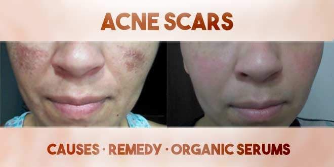 Featured visual summarizing evidence-based guidance related to Acne Scars - Causes, Remedy, Organic Serums.
