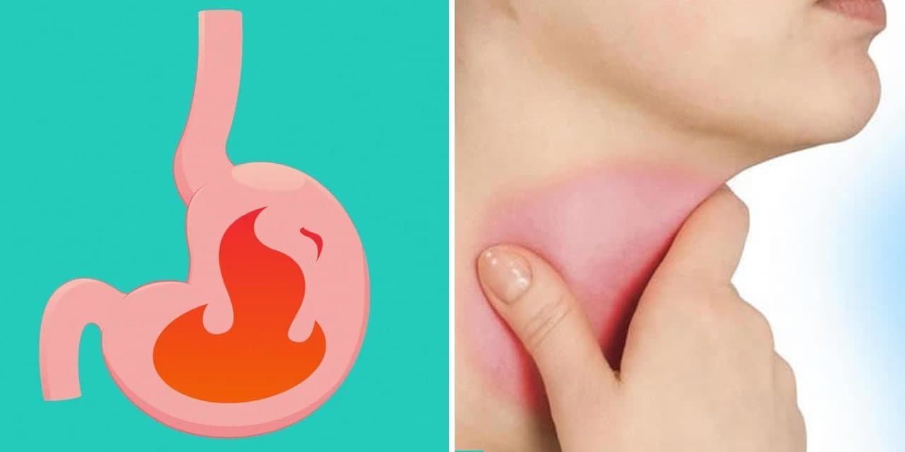 Silent Acid Reflux: Manifestation, Treatment and Latest Research